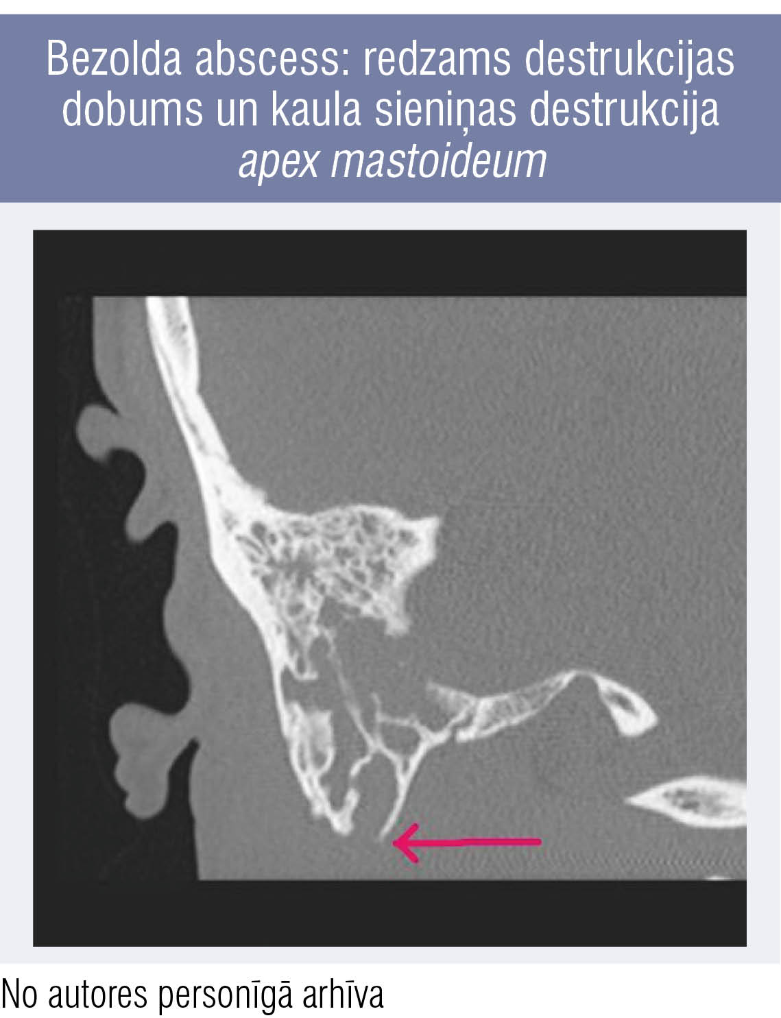 Bezolda abscess: redzams destrukcijas dobums un kaula sieniņas destrukcija apex mastoideum