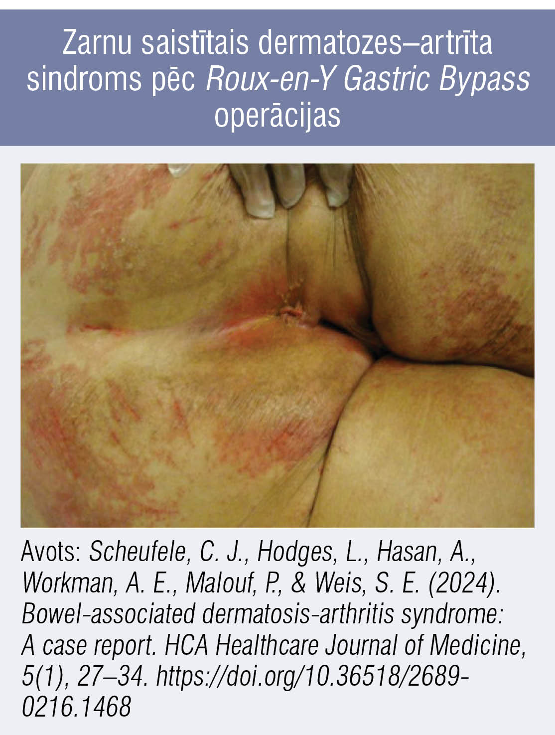 Zarnu saistītais dermatozes–artrīta sindroms pēc Roux-en-Y Gastric Bypass operācijas