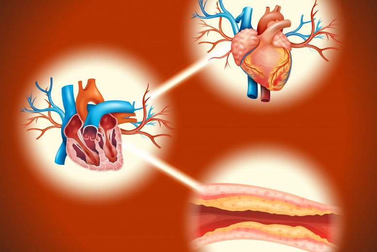 Hiperholesterinēmijas ārstēšana. Mērķtiecīgi, ātri un noturīgi