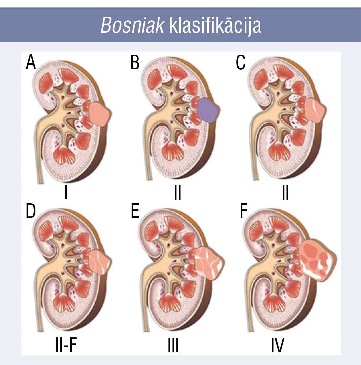 Bosniak klasifikācija