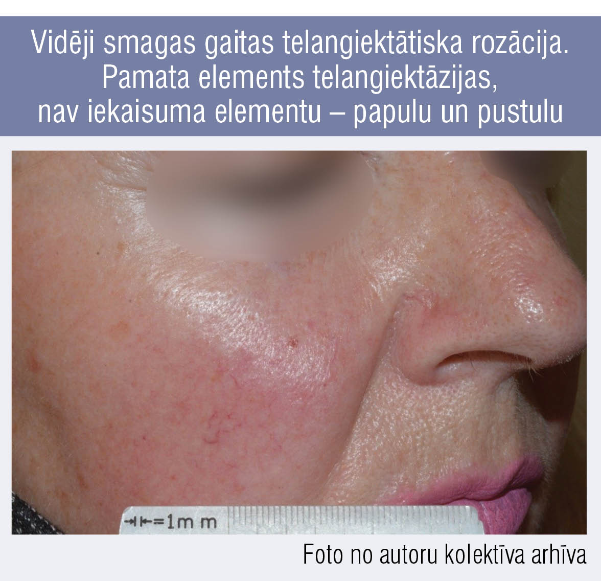 Vidēji smagas gaitas telangiektātiska rozācija. Pamata elements telangiektāzijas, nav iekaisuma elementu – papulu un pustulu