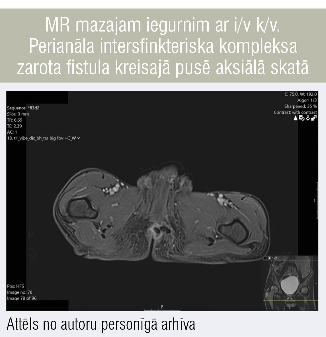 MR mazajam iegurnim ar i/v k/v. Perianāla intersfinkteriska kompleksa zarota fistula kreisajā pusē aksiālā skatā
