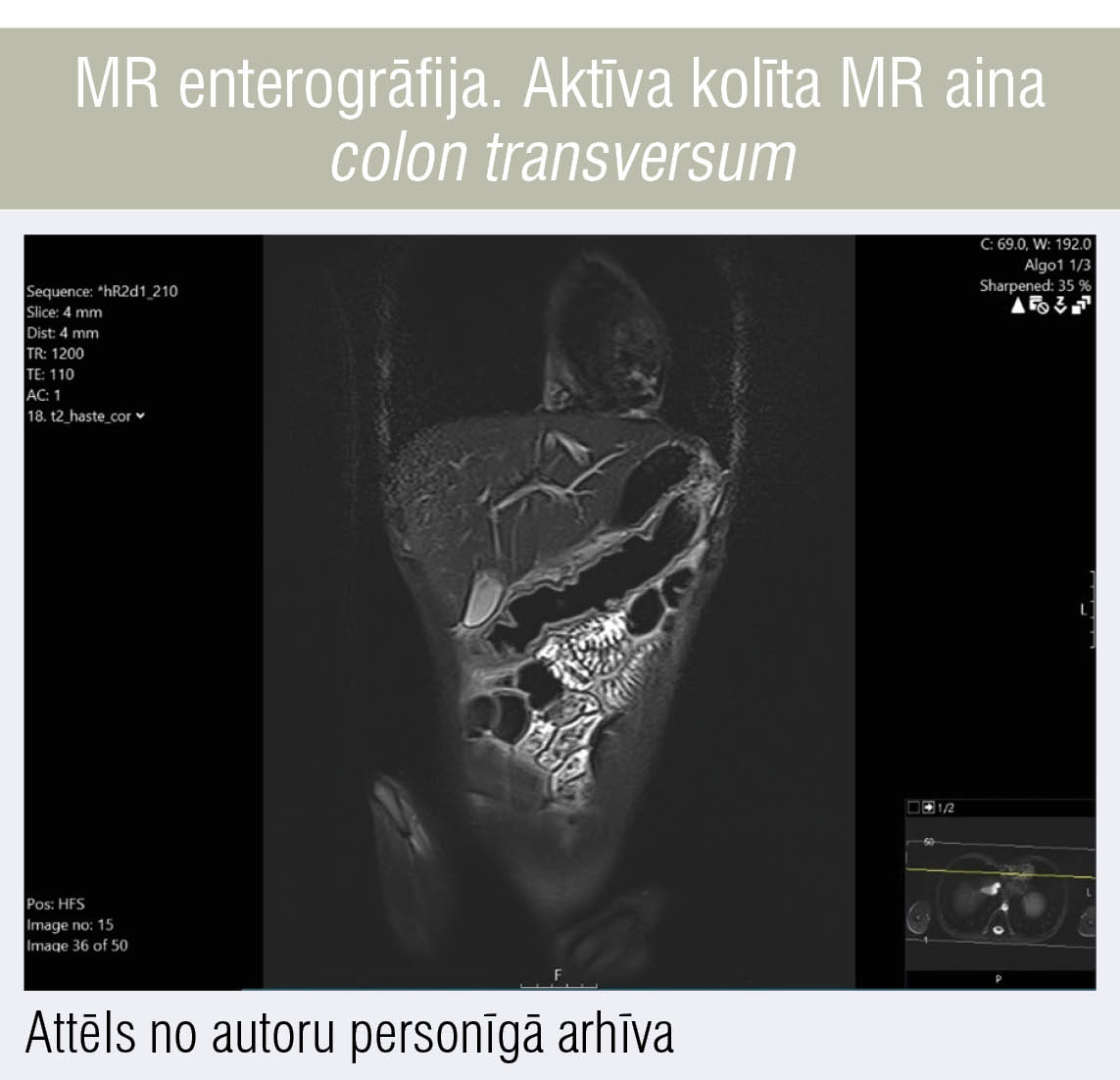 MR enterogrāfija. Aktīva kolīta MR aina colon transversum