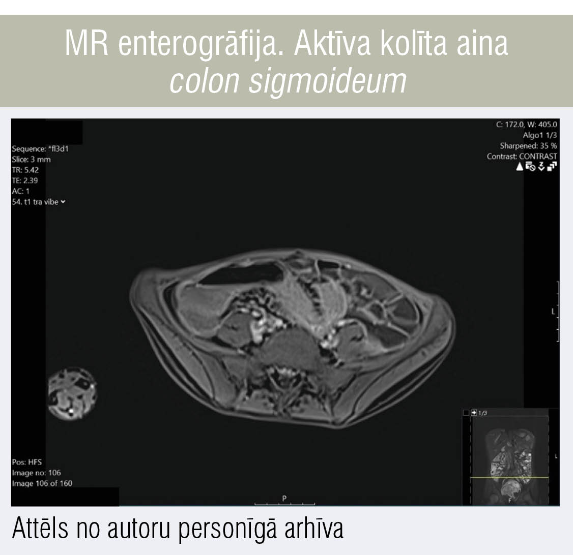 MR enterogrāfija. Aktīva kolīta aina colon sigmoideum