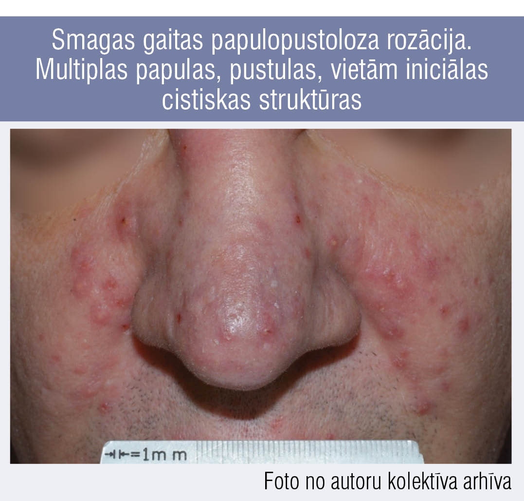 Smagas gaitas papulopustoloza rozācija. Multiplas papulas, pustulas, vietām iniciālas cistiskas struktūras