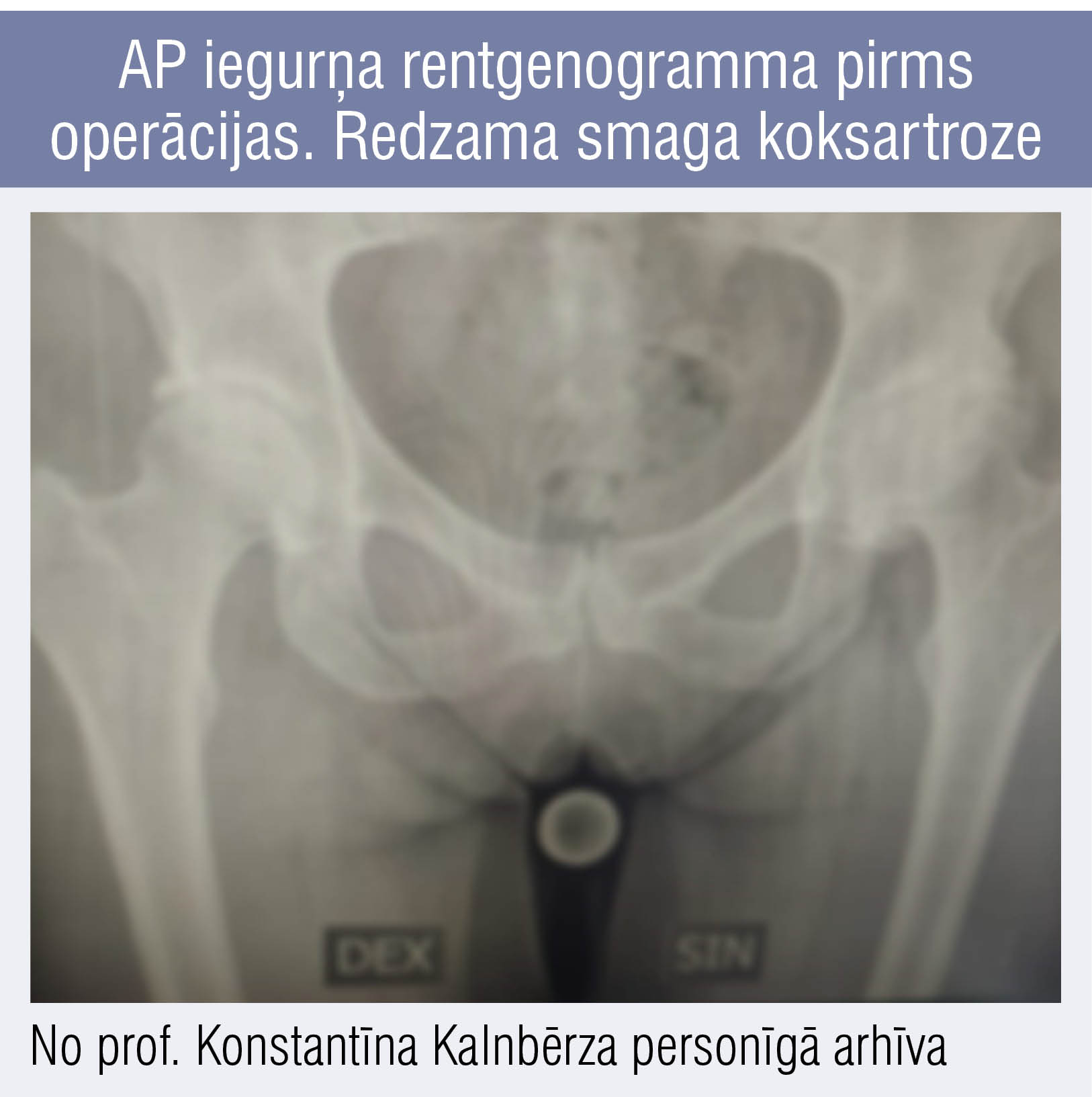 AP iegurņa rentgenogramma pirms operācijas. Redzama smaga koksartroze