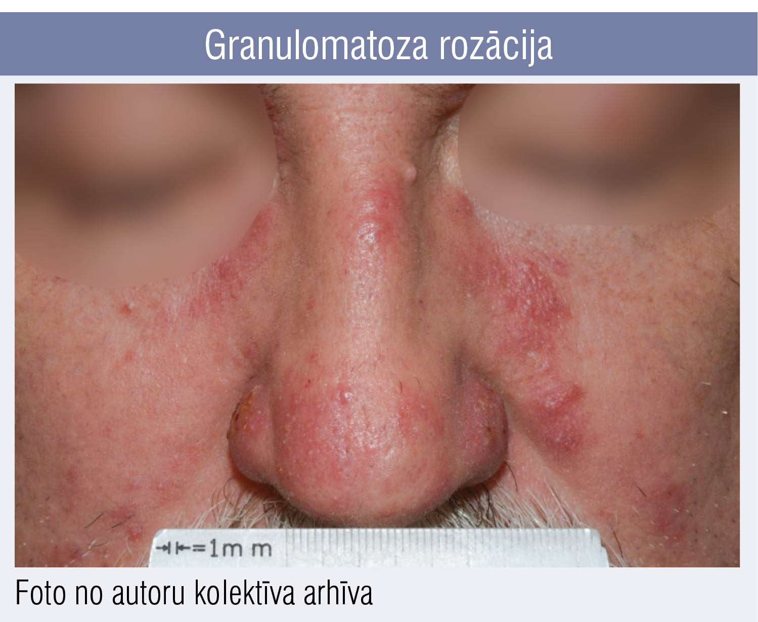 Granulomatoza rozācija