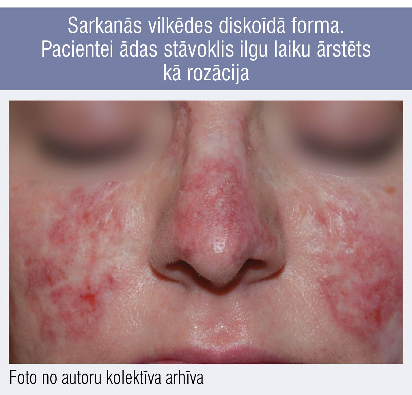 Sarkanās vilkēdes diskoīdā forma. Pacientei ādas stāvoklis ilgu laiku ārstēts kā rozācija
