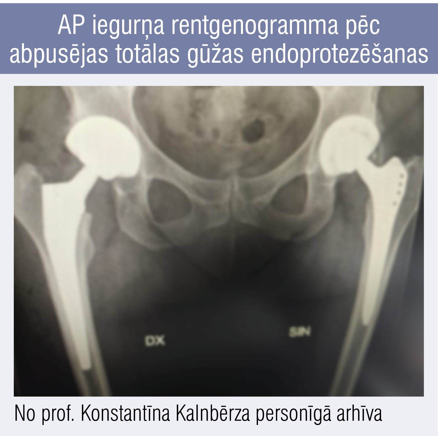 AP iegurņa rentgenogramma pēc
abpusējas totālas gūžas endoprotezēšanas
