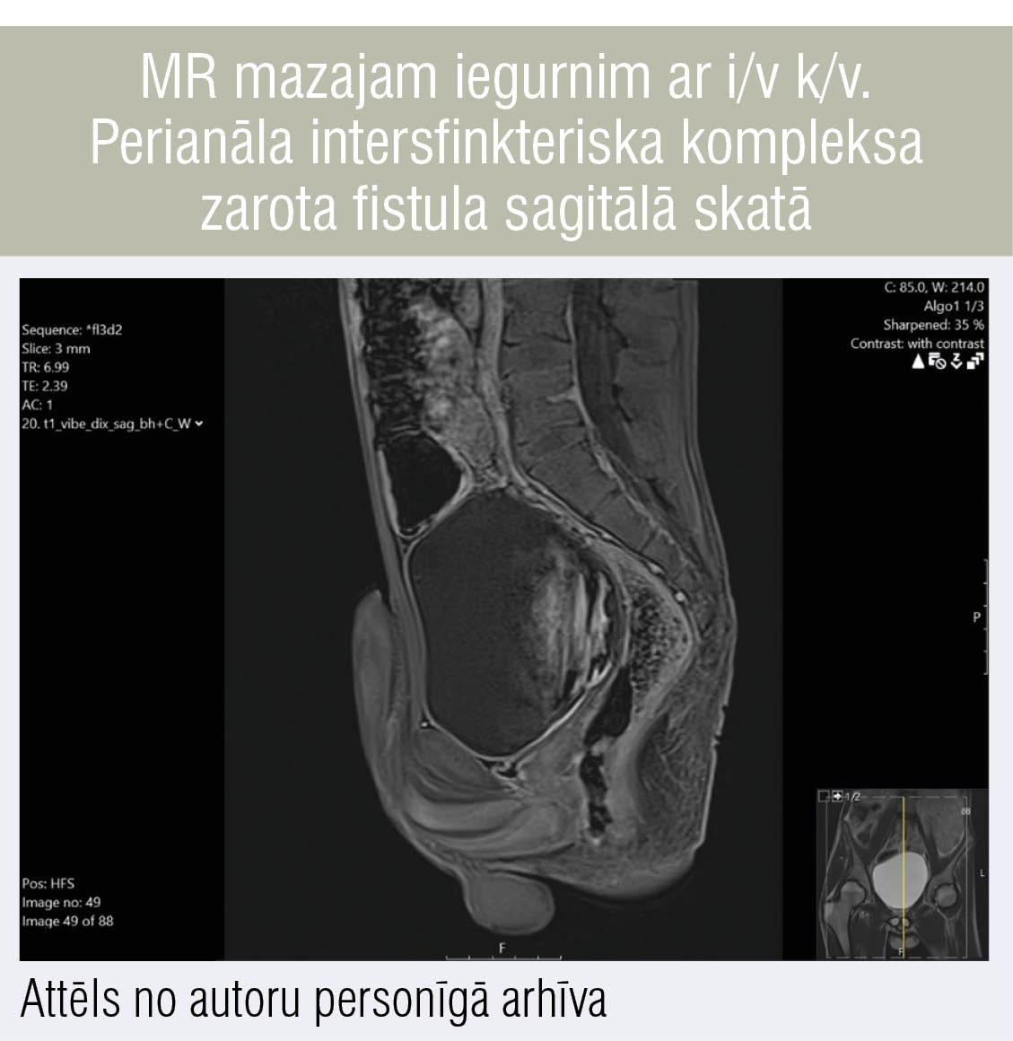 MR mazajam iegurnim ar i/v k/v. Perianāla intersfinkteriska kompleksa zarota fistula sagitālā skatā