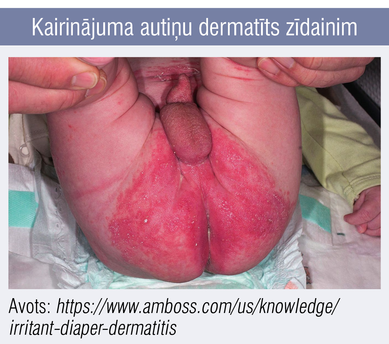 Kairinājuma autiņu dermatīts zīdainim