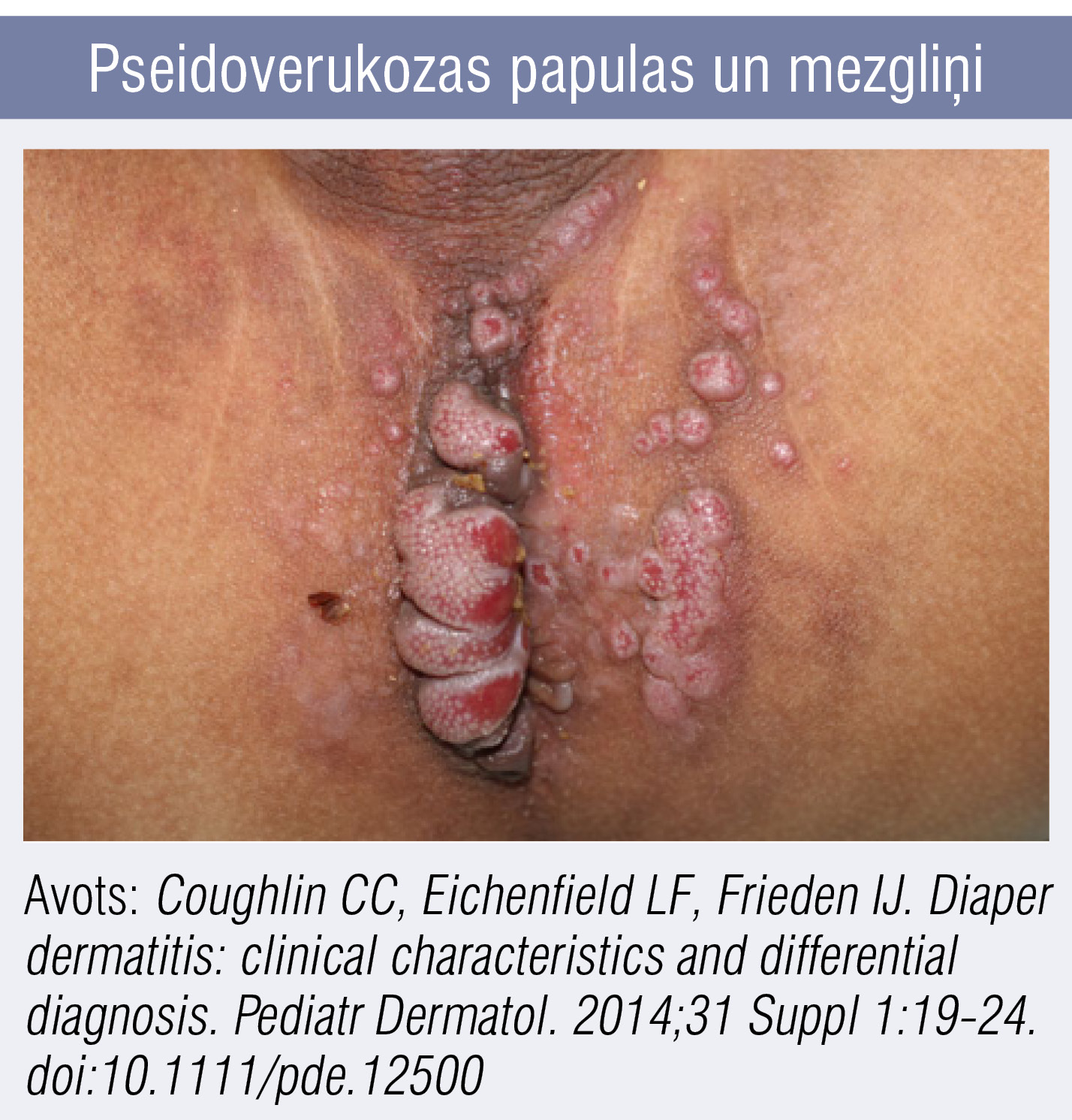 Pseidoverukozas papulas un mezgliņi
