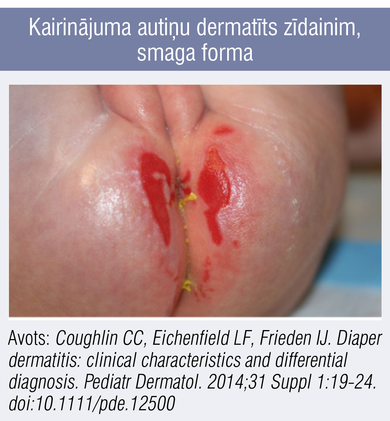 Kairinājuma autiņu dermatīts zīdainim, smaga forma