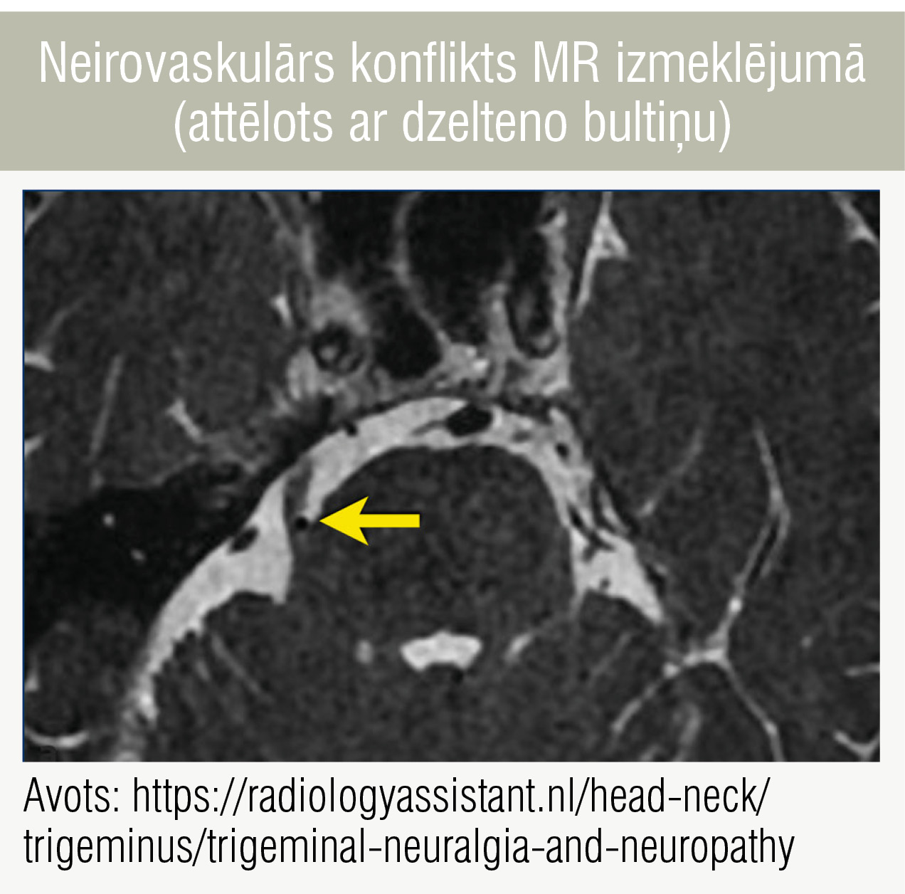 Neirovaskulārs konflikts MR izmeklējumā (attēlots ar dzelteno bultiņu)