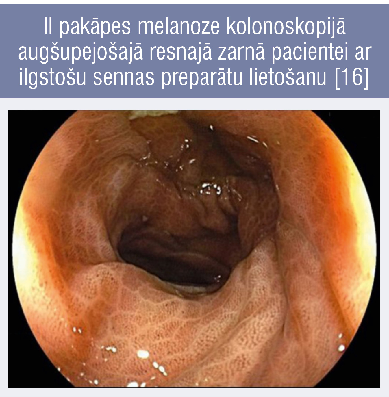 II pakāpes melanoze kolonoskopijā
augšupejošajā resnajā zarnā pacientei ar ilgstošu sennas preparātu lietošanu [16]