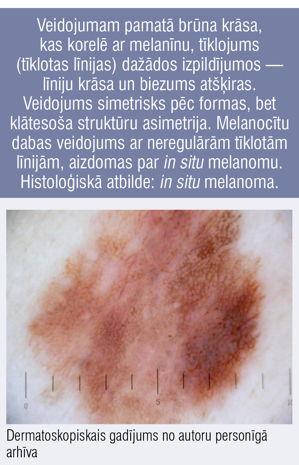 Veidojumam pamatā brūna krāsa, kas korelē ar melanīnu, tīklojums (tīklotas līnijas) dažādos izpildījumos — līniju krāsa un biezums atšķiras. Veidojums simetrisks pēc formas, bet klātesoša struktūru asimetrija. Melanocītu dabas veidojums ar neregulārām tīklotām līnijām, aizdomas par in situ melanomu. Histoloģiskā atbilde: in situ melanoma.