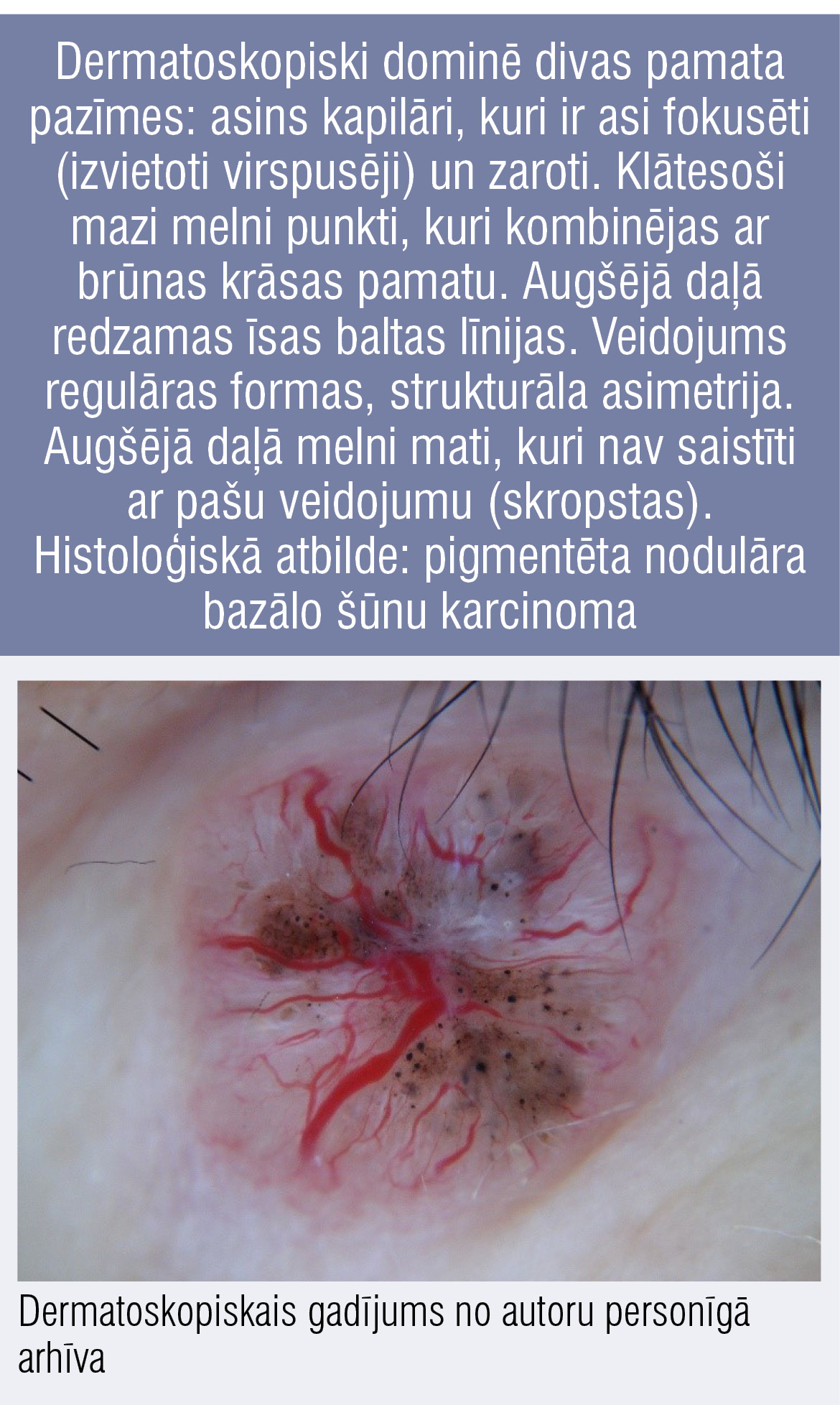 Dermatoskopiski dominē divas pamata pazīmes: asins kapilāri, kuri ir asi fokusēti (izvietoti virspusēji) un zaroti. Klātesoši mazi melni punkti, kuri kombinējas ar brūnas krāsas pamatu. Augšējā daļā redzamas īsas baltas līnijas. Veidojums regulāras formas, strukturāla asimetrija. Augšējā daļā melni mati, kuri nav saistīti ar pašu veidojumu (skropstas). Histoloģiskā atbilde: pigmentēta nodulāra bazālo šūnu karcinoma