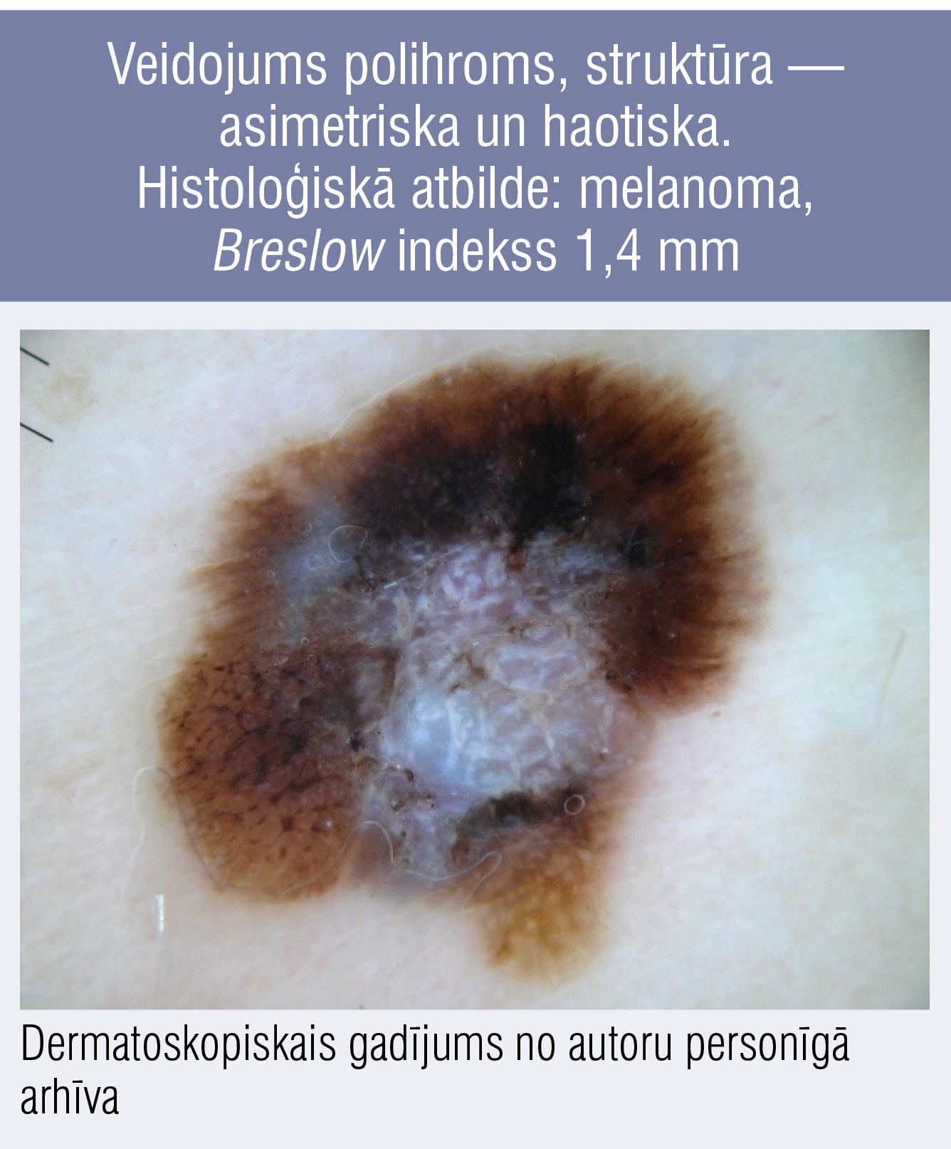 Veidojums polihroms, struktūra — asimetriska un haotiska. Histoloģiskā atbilde: melanoma, Breslow indekss 1,4 mm