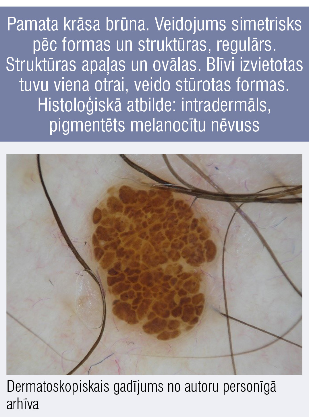Pamata krāsa brūna. Veidojums simetrisks pēc formas un struktūras, regulārs. Struktūras apaļas un ovālas. Blīvi izvietotas tuvu viena otrai, veido stūrotas formas. Histoloģiskā atbilde: intradermāls, pigmentēts melanocītu nēvuss