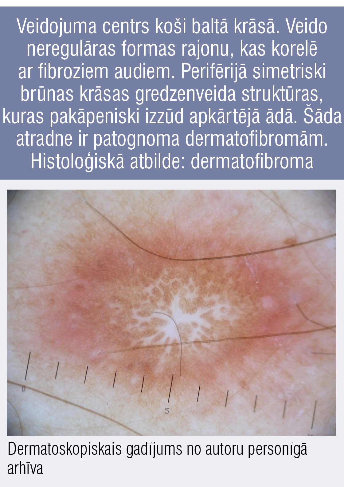 Veidojuma centrs koši baltā krāsā. Veido neregulāras formas rajonu, kas korelē ar fibroziem audiem. Perifērijā simetriski brūnas krāsas gredzenveida struktūras, kuras pakāpeniski izzūd apkārtējā ādā. Šāda atradne ir patognoma dermatofibromām. Histoloģiskā atbilde: dermatofibroma