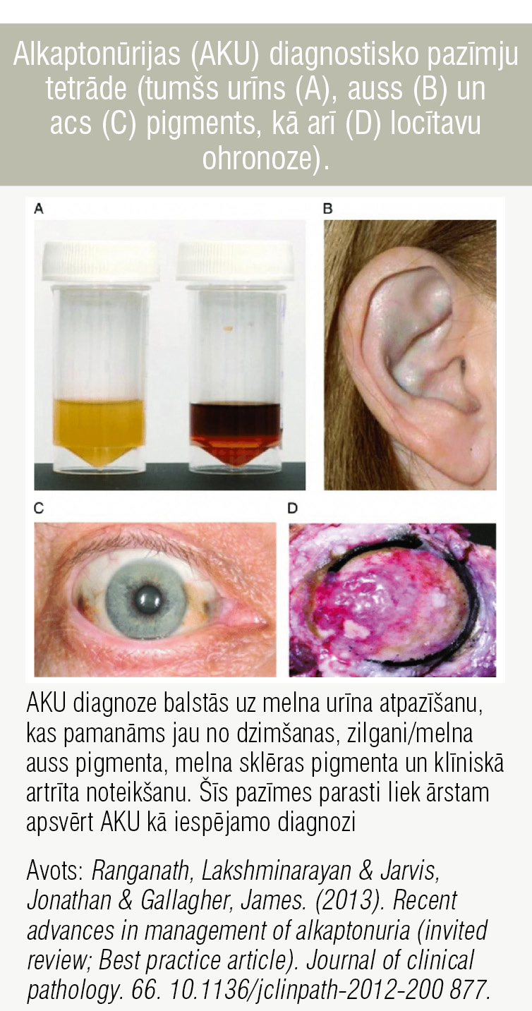 Alkaptonūrijas (AKU) diagnostisko pazīmju tetrāde (tumšs urīns (A), auss (B) un acs (C) pigments, kā arī (D) locītavu ohronoze).