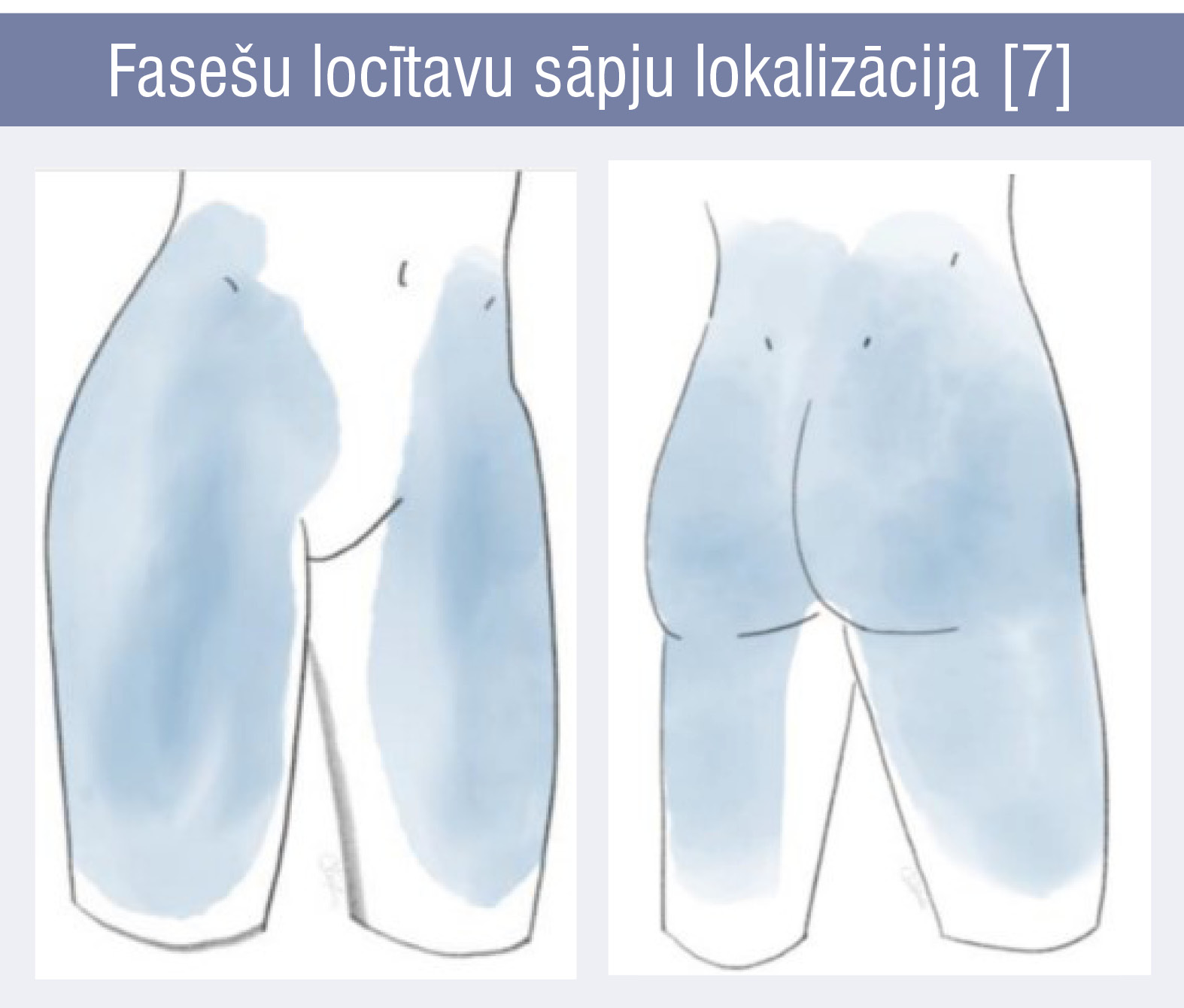 Fasešu locītavu sāpju lokalizācija [7]