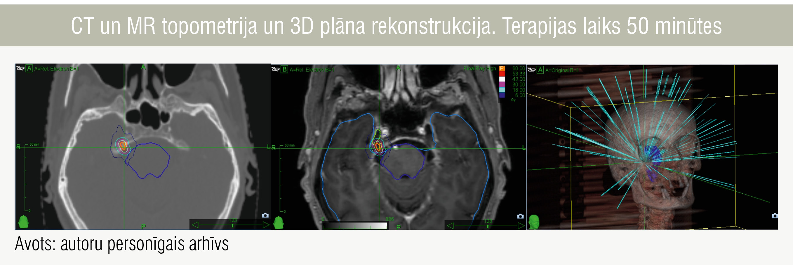 CT un MR topometrija un 3D plāna rekonstrukcija. Terapijas laiks 50 minūtes
