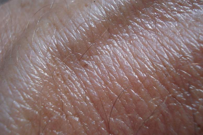 Augstas devas D vitamīns ķīmij- un staru terapijas radīta ādas bojājuma seku mazināšanai