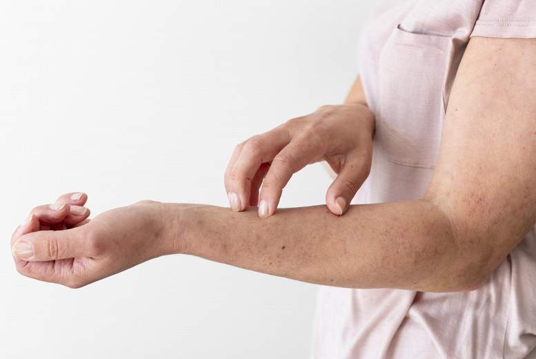 Atopiskais dermatīts saistīts ar jostas rozi pieaugušajiem