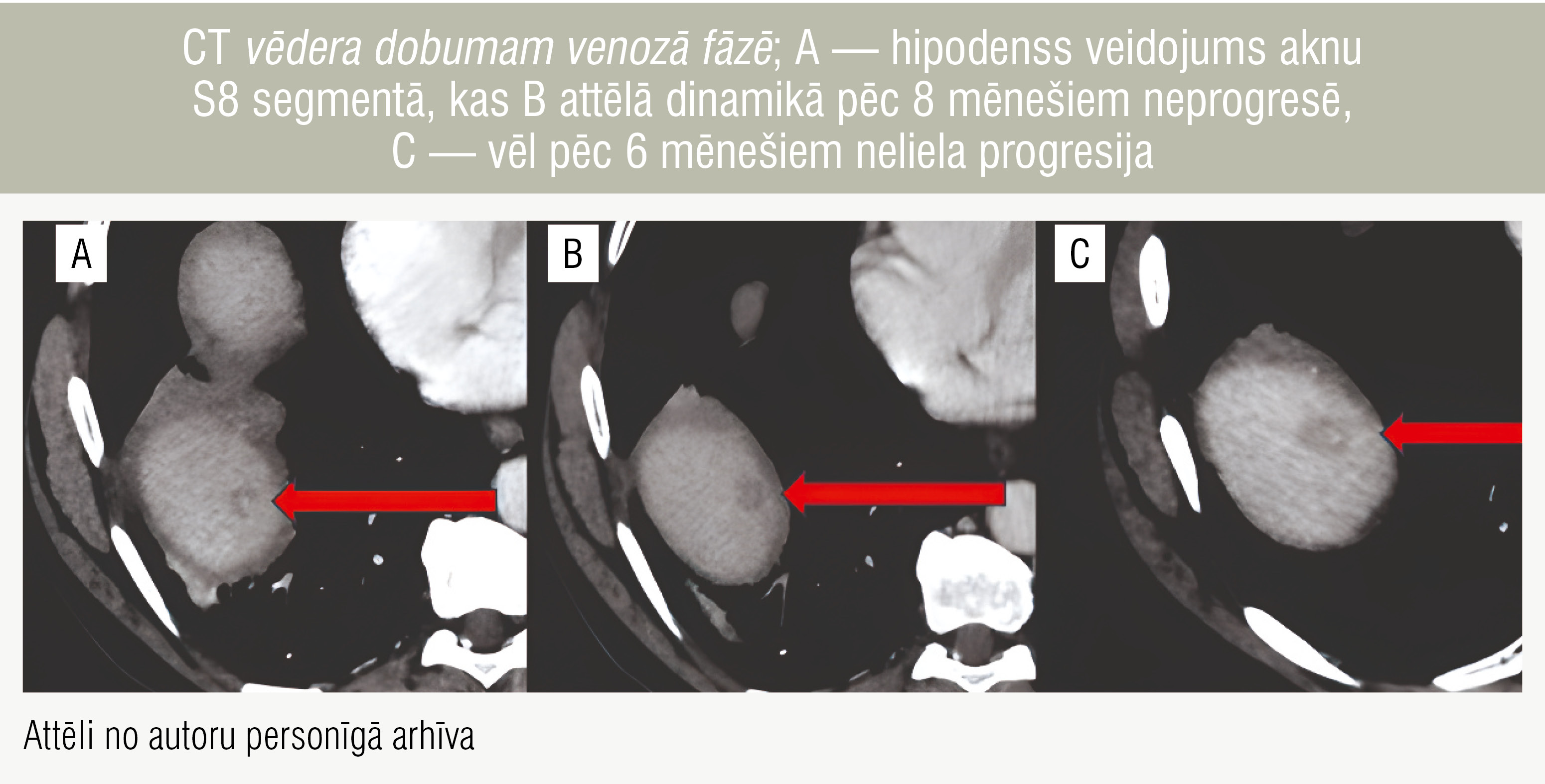 CT vēdera dobumam venozā fāzē; A — hipodenss veidojums aknu S8 segmentā, kas B attēlā dinamikā pēc 8 mēnešiem neprogresē, C — vēl pēc 6 mēnešiem neliela progresija