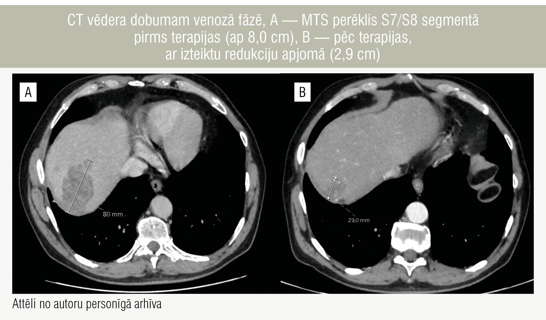 CT vēdera dobumam venozā fāzē, A — MTS perēklis S7/S8 segmentā pirms terapijas (ap 8,0 cm), B — pēc terapijas, ar izteiktu redukciju apjomā (2,9 cm)