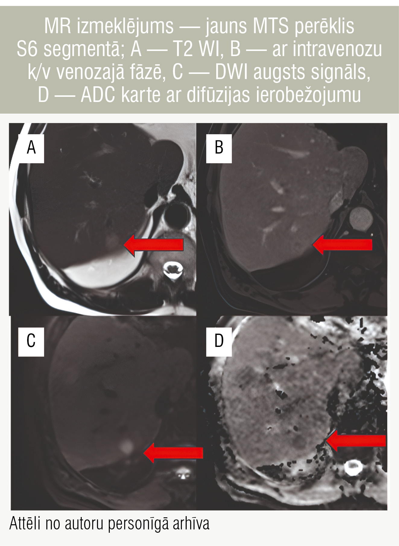MR izmeklējums — jauns MTS perēklis S6 segmentā; A — T2 WI, B — ar intravenozu k/v venozajā fāzē, C — DWI augsts signāls, D — ADC karte ar difūzijas ierobežojumu