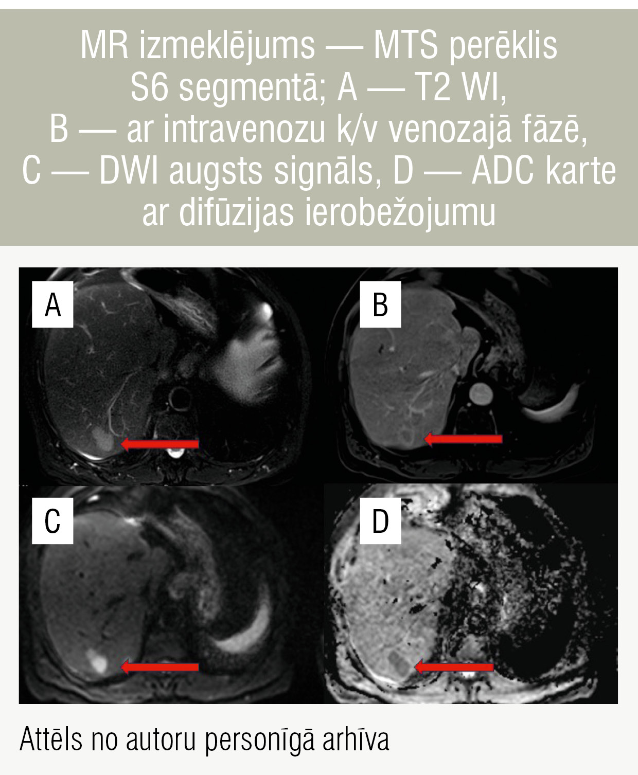 MR izmeklējums — MTS perēklis S6 segmentā; A — T2 WI, B — ar intravenozu k/v venozajā fāzē, C — DWI augsts signāls, D — ADC karte ar difūzijas ierobežojumu