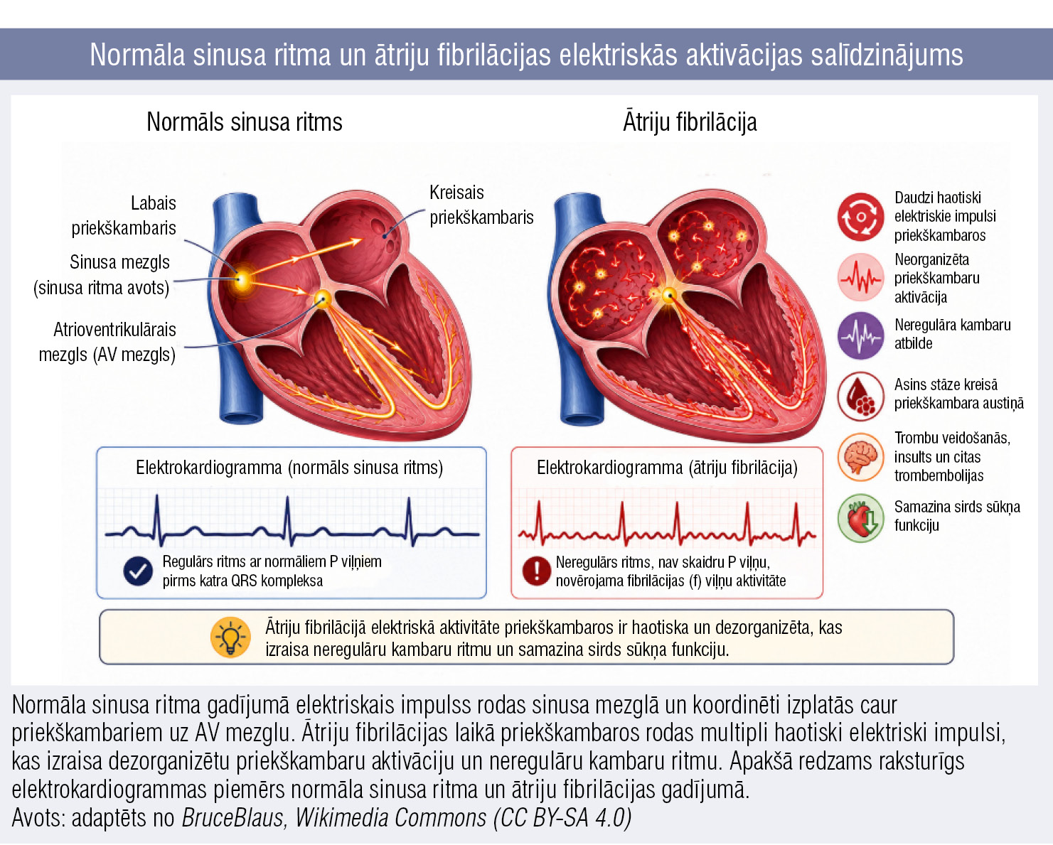 Normāla sinusa ritma un ātriju fibrilācijas elektriskās aktivācijas salīdzinājums