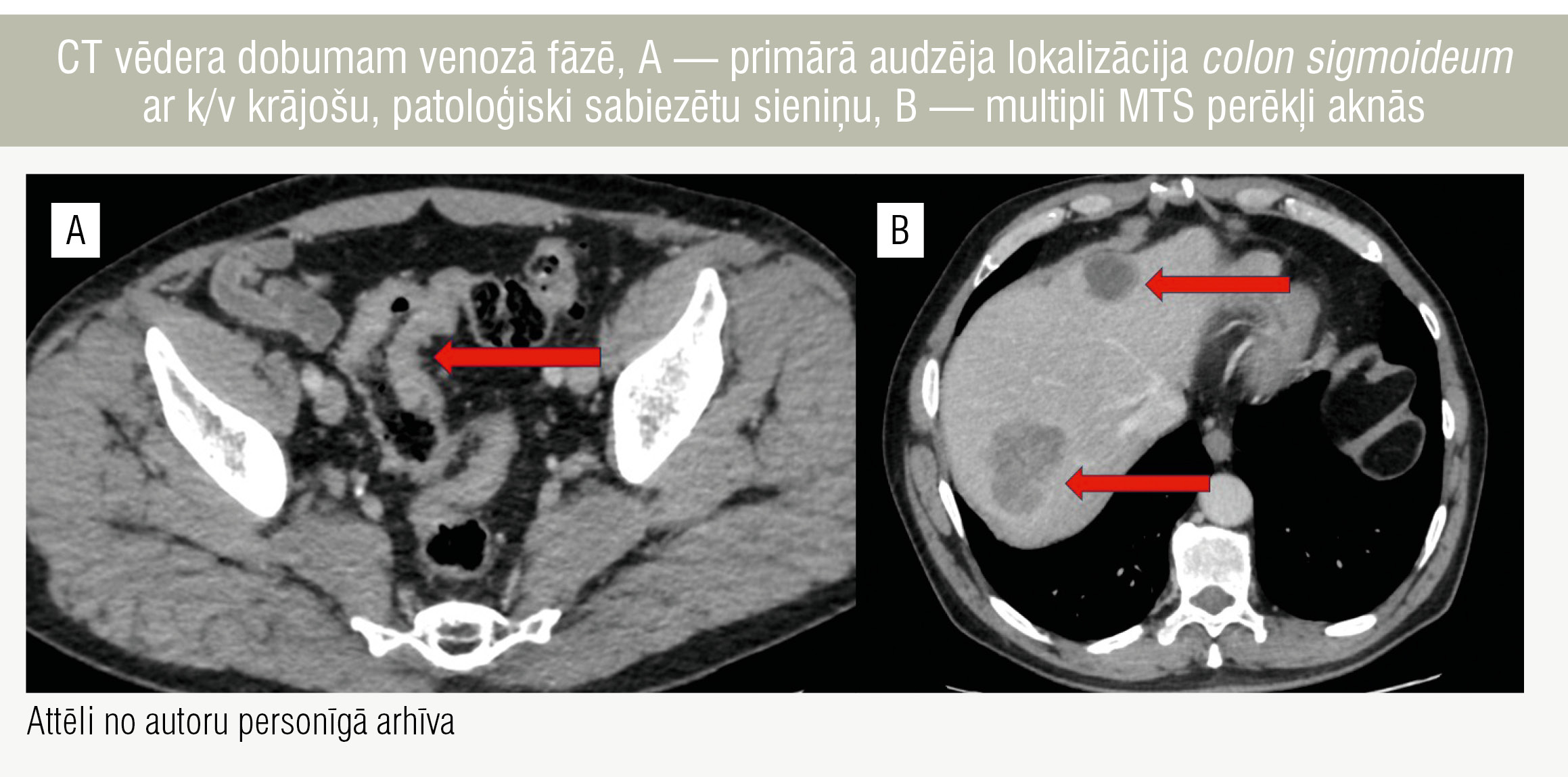 CT vēdera dobumam venozā fāzē, A — primārā audzēja lokalizācija colon sigmoideum ar k/v krājošu, patoloģiski sabiezētu sieniņu, B — multipli MTS perēkļi aknās