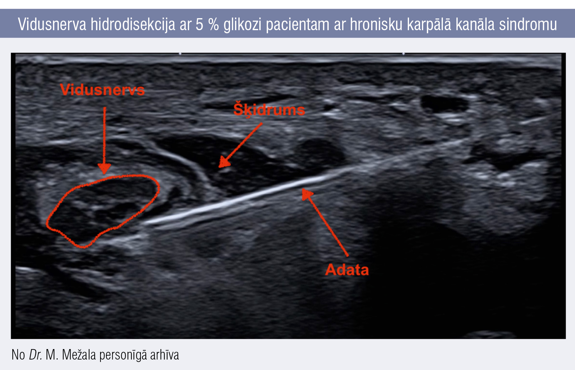 Vidusnerva hidrodisekcija ar 5 % glikozi pacientam ar hronisku karpālā kanāla sindromu